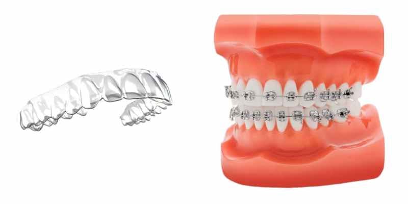 Crowded teeth example