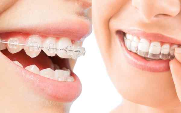 Invisalign vs Braces